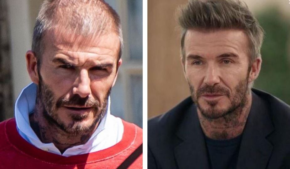 david-beckham-hair-transplant-before-and-after